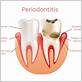 periodontal gum disease white plains