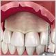 periodontal pocket reduction
