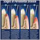 periodontitis gums disease