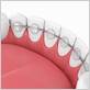 permanent metal retainer electric toothbrushes