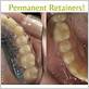 permanent retainer gum disease