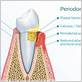 phedonal gum disease