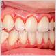 pics of gingivitis