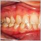 pictures of early gum disease