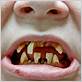 pictures of rotten teeth and gum disease
