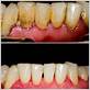 pier donalson gum disease