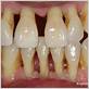 piero gum disease