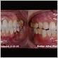 pinhole gum surgery periodontal disease
