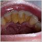plaque buildup gum disease