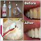 plaque-removing effect of a toothbrush dental floss and a toothpick
