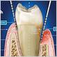 pockets in the gums gum disease