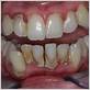 porcelain veneers and gum disease