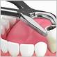 power extraction dental usa