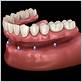 power plate dental implants