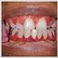 prednisone gum disease