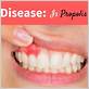 propolis extract for healing gum disease