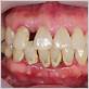 psoriasis gum disease