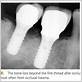 pulsating pain after dental implant