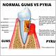 pyria gum disease images