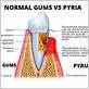 pyria gum disease photos