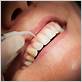 rancho bernardo gum disease