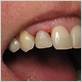 receding gum around dental implant