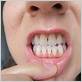 receding gums but no gum disease