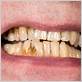 receding gums celiac disease