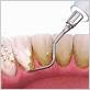 redwood city gum disease treatments