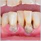 regrow gums periodontal disease