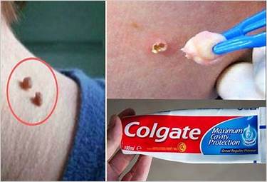 removing a skin tag with dental floss