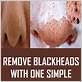 removing blackheads with floss picks