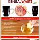 removing genital warts with dental floss