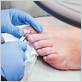 removing ingrown toenail with dental floss