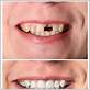 restoring teeth after gum disease