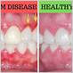 reverse gum disease fast