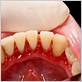 reverse tooth decay and gum disease