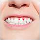 reversing gum disease don't miss your window of opportunitycolgate