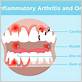 rheumatoid arthritis and gum disease