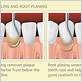 root panning with advanced gum disease