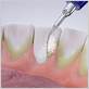 roselle gum disease treatment