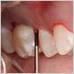 rpe treatment for gum disease treatment