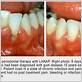 san antonio gum disease treatment
