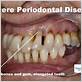 severe gum disease symptoms