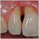 severe periodontitis treatment