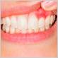 sign of autoimmune disease on gums