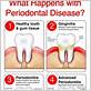 signs of periodontal gum disease