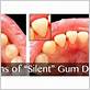 silent gum disease
