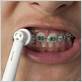 sonicare for braces