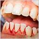 sore bleeding gums not gum disease